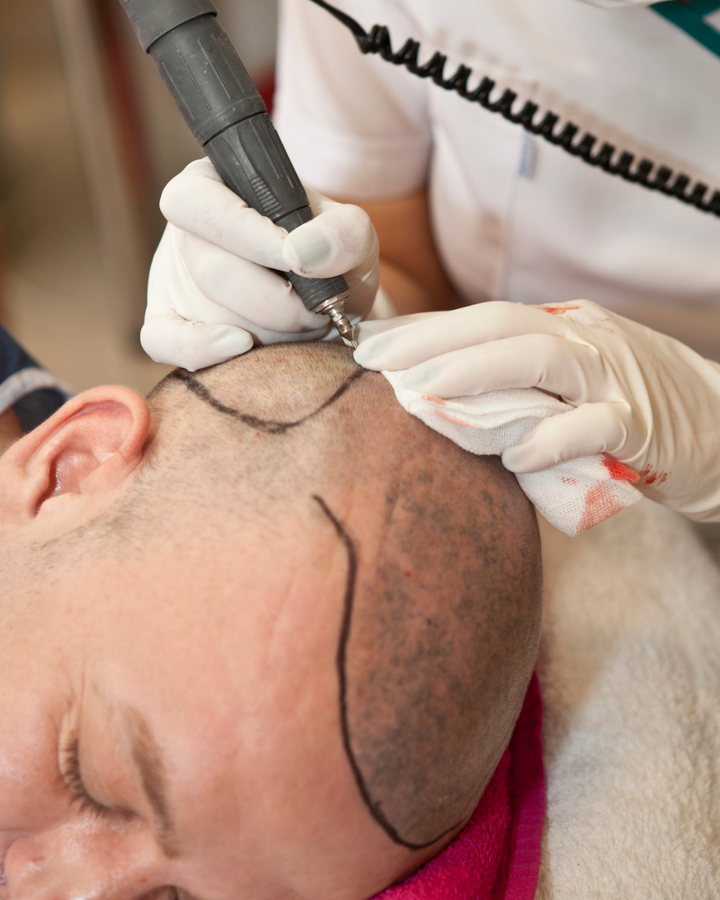 Is hair transplant the way to go for you?