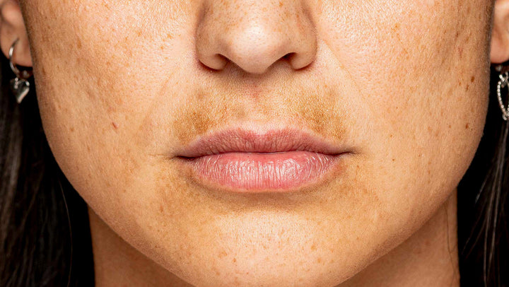 Melasma Mustache - Photo Courtesy The Ohio State University