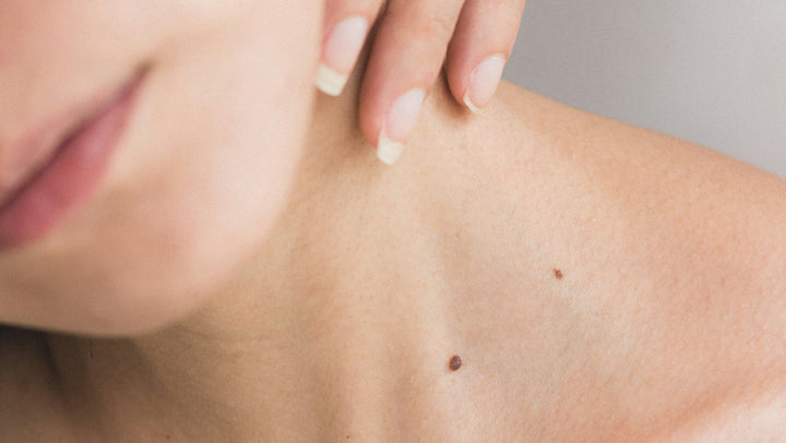 How to Remove Skin Tags Safely, According to Dermatologists